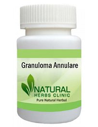 Herbal Product for Granuloma Annulare