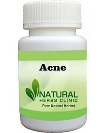 Herbal Product for Acne